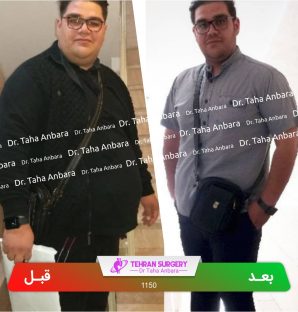 عکس قبل و بعد جراحی لاغری