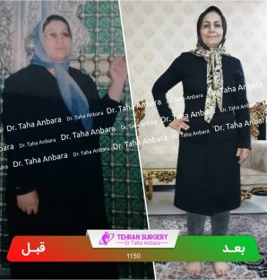 عکس قبل و بعد جراحی لاغری