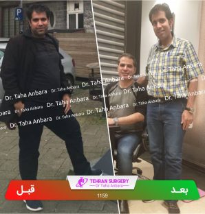 عکس قبل و بعد جراحی لاغری