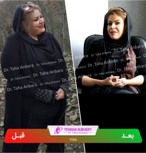 عکس قبل و بعد جراحی لاغری