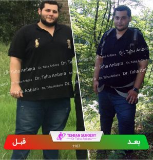 عکس قبل و بعد جراحی لاغری