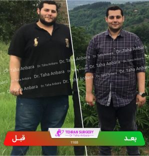 عکس قبل و بعد جراحی لاغری