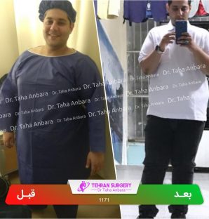 عکس قبل و بعد جراحی لاغری