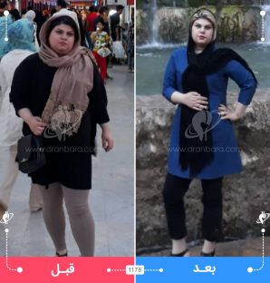 عکس قبل و بعد جراحی لاغری