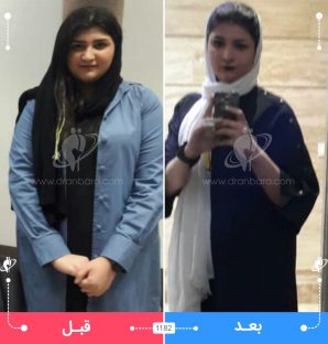 عکس قبل و بعد جراحی لاغری