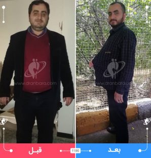 عکس قبل و بعد جراحی لاغری