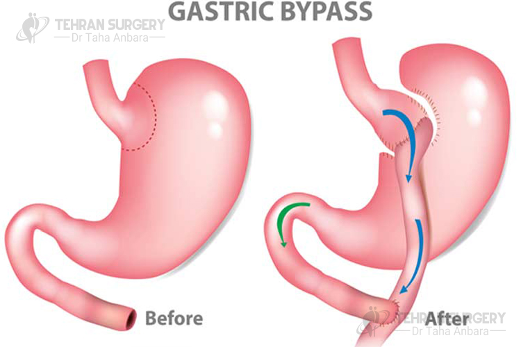 what kind of calcium for gastric bypass